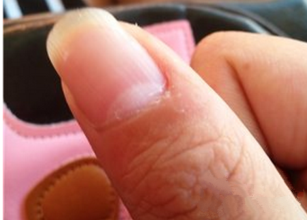 指甲上竖线有什么预兆 细数指甲上的求救信号