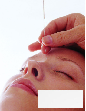 针灸疗法对症缓解头痛 外感头痛针灸风池穴